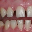 Большая щель между зубами: опасно ли это и как убрать?