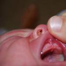 Что такое подрезание уздечки верхней губы и зачем нужна пластика