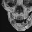 Классификация переломов челюстей