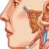 Нейросенсорная тугоухость (неврит слухового нерва): симптомы, лечение, диагностика, прогноз