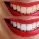 Лучшее домашнее отбеливание зубов: обзор средств и способов Как отбелить зубы в дом условиях