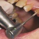 Процедура наращивания зуба на штифт: используемые технологии, составляющие цены