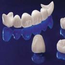 Металлокерамические коронки на передние зубы: плюсы и минусы