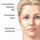 Идиопатическая невропатия лицевого нерва (паралич Белла) Невропатия лицевого нерва диагностика