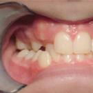 Mettre un appareil dentaire à votre enfant : quand et comment