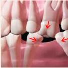 What are spaces between teeth