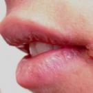 Come curare rapidamente le marmellate agli angoli della bocca