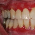 Kraujuojančių dantenų gydymas vandenilio peroksidu