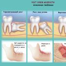 Apa yang harus dilakukan setelah pencabutan gigi bungsu: akibat, komplikasi, pembilasan, nyeri, perlu dicabut atau tidak
