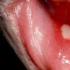 Sores on the lips - how common and unpleasant the problem is