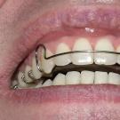 Teeth Alignment Plates - how to achieve the perfect smile