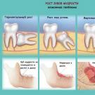 É necessário remover os dentes do siso: por que e em que casos os dentes do siso são removidos nome