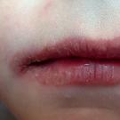 Causes d'apparition aux commissures des lèvres