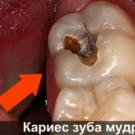 É necessário retirar um dente do siso: indicações para remoção, possíveis consequências