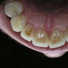 Шүд яагаад хар өнгөтэй болсон бэ: паалан нь гадна болон дотор, үндэс, ломбоны доор харанхуйлах шалтгаанууд Насанд хүрэгчдийн шүдэнд хар өнгөтэй болдог