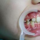 A quel âge un enfant doit-il porter un appareil dentaire ?