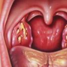 Tampões caseosos nas lacunas das amígdalas (na garganta)