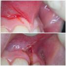 Por que o frênulo dos lábios superiores e inferiores é aparado em crianças e em que casos é necessária a cirurgia plástica?