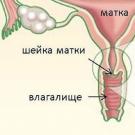 Tratamento de ectopia cervical ou cervical crônica