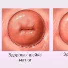 Como tratar a erosão cervical?