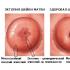 O que é chamado de ectopia cervical do colo do útero