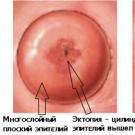 Erosão cervical - um diagnóstico que precisa ser tratado O que é erosão cervical e como é
