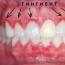Укрепете венците, ако зъбите се разклатят у дома: възможно ли е?