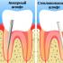 O que fazer se um dente quebrar e a raiz ficar na gengiva: é possível restaurar uma unidade dentária?