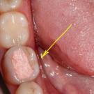 Por quanto tempo um adulto pode manter arsênico no dente?