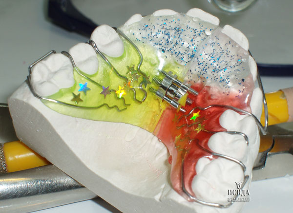 Поставили пластину на зубы. Ортодонтическая пластинка (с использования винта Бертони). Пластинка на нижнюю челюсть. Пластинка для зубов на нижней челюсти.