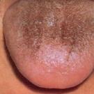 Penyebab dan pengobatan plak coklat di lidah anak